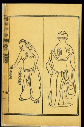 Chinese woodcut: Abscesses - 'left hand touching abscess' etc