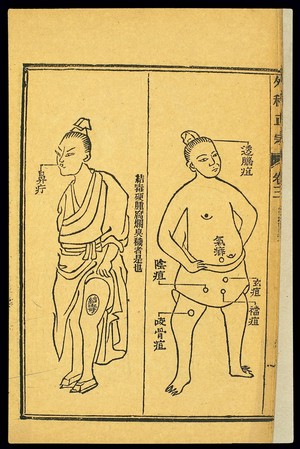 view Chinese woodcut: Various abscesses