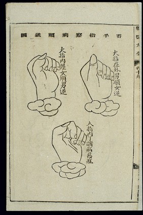 Chinese woodcut: Prognosis by finger inspection