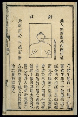 view Chinese woodcut: Sores on the nape