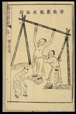 view Chinese woodcut: Orthopedic technique to treat prolapsed disk