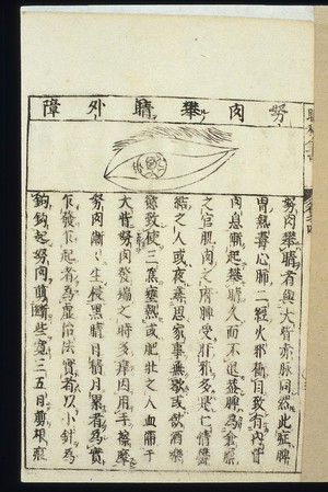 view Japanese/Chinese woodcut: Pathology of pterygium