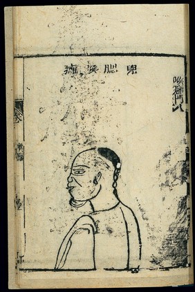 Chinese woodcut: Pathology of 'pouchy jaw' throat abscess