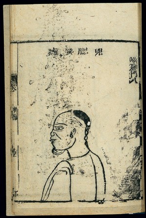 view Chinese woodcut: Pathology of 'pouchy jaw' throat abscess