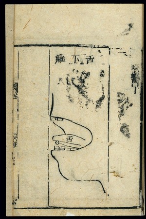 view Chinese C19 woodcut: Abscesses beneath the tongue