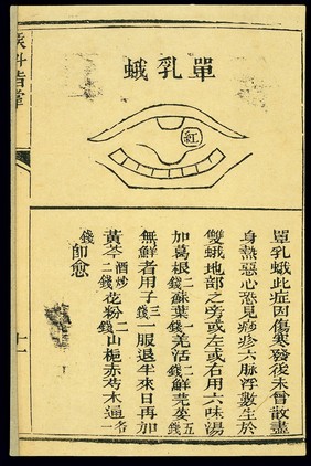 Chinese C19 woodcut: Throat conditions, tonsillitis