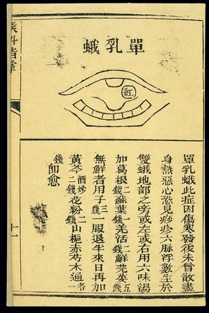 view Chinese C19 woodcut: Throat conditions, tonsillitis