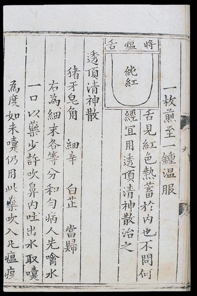 Chinese tongue diagnosis diagram: 'Incipient plague' tongue