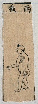 Mid C20 Chinese medical illustration in trad. style: Smallpox