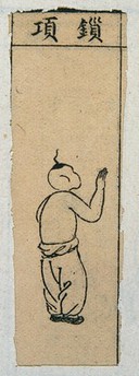 Mid C20 Chinese medical illustration in trad. style: Smallpox