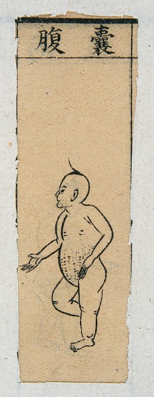 view Mid C20 Chinese medical illustration in trad. style: Smallpox