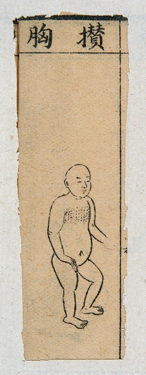 view Mid C20 Chinese medical illustration in trad. style: Smallpox