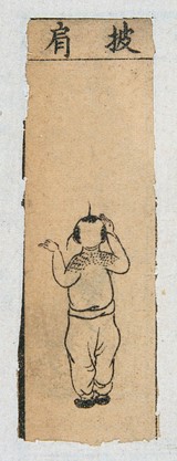 Mid C20 Chinese medical illustration in trad. style: Smallpox