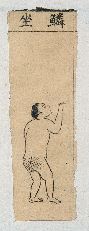 view Mid C20 Chinese medical illustration in trad. style: Smallpox