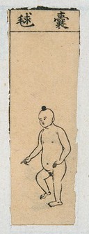 Mid C20 Chinese medical illustration in trad. style: Smallpox