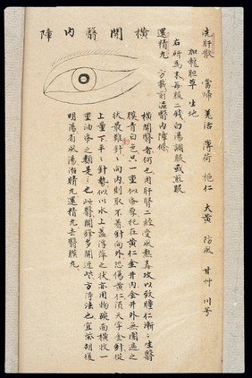 Illustration from Ming Chinese ophthalmology text, Ms copy