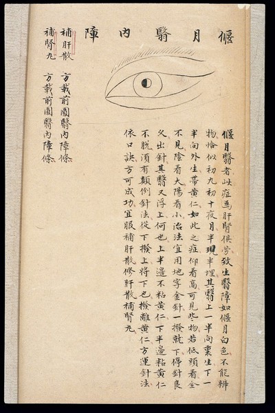 Illustration from Ming Chinese ophthalmology text, Ms copy