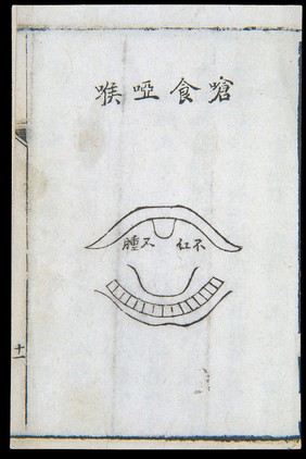 C18 Chinese woodcut: Choking and hoarseness