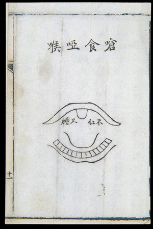 view C18 Chinese woodcut: Choking and hoarseness