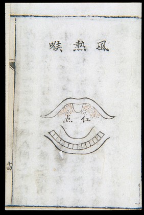 C18 Chinese woodcut: Wind-heat throat