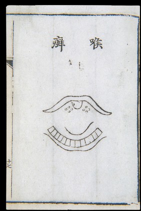 C18 Chinese woodcut: Tinea-like throat disease