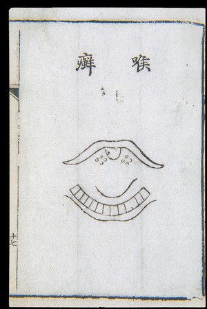 view C18 Chinese woodcut: Tinea-like throat disease