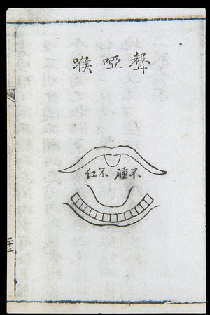 view C18 Chinese woodcut: Hoarse-voice throat