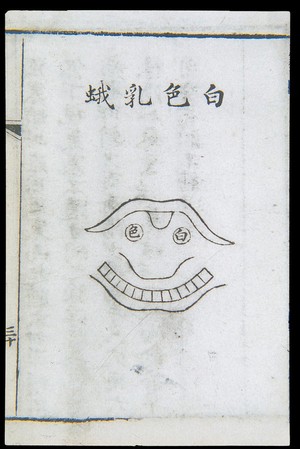 view C18 Chinese woodcut: White tonsillitis