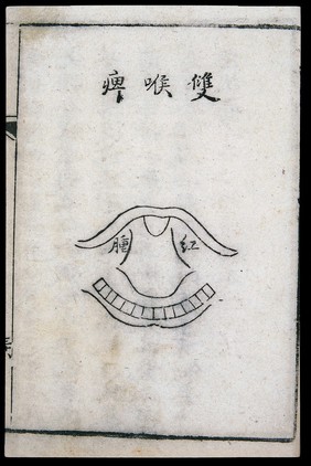 C18 Chinese woodcut: Double-sided pharyngitis