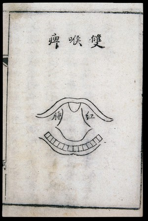 view C18 Chinese woodcut: Double-sided pharyngitis