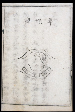 view C18 Chinese woodcut: One-sided pharyngitis