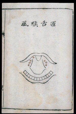 view C18 Chinese woodcut: Laryngitis extending to the tongue