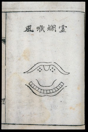 view C18 Chinese woodcut: Deficiency-putrefaction laryngitis