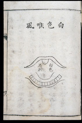 C18 Chinese woodcut: White laryngitis