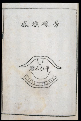 C18 Chinese woodcut: Over-exertion laryngitis