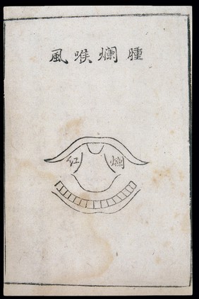 C18 Chinese woodcut: Swollen-putrid laryngitis