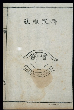 view C18 Chinese woodcut: Lung-cold laryngitis