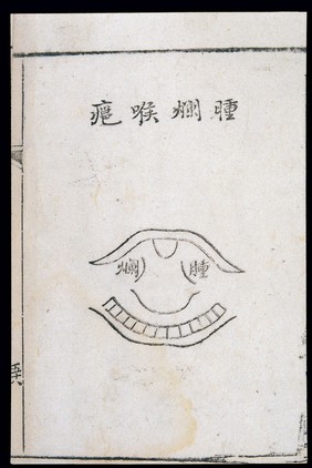 C18 Chinese woodcut: Swollen-putrid throat abscess