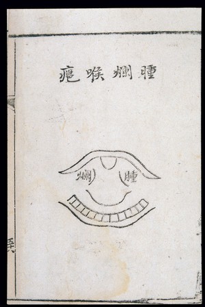 view C18 Chinese woodcut: Swollen-putrid throat abscess