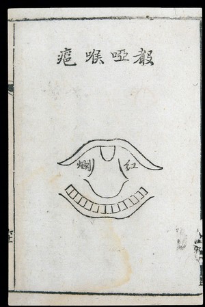 view C18 Chinese woodcut: Throat abscess with hoarse voice