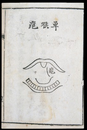 C18 Chinese woodcut: One-sided throat abscess