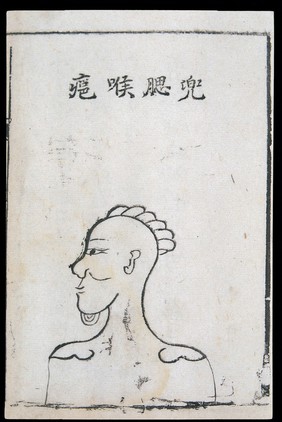 C18 Chinese woodcut: Cheek-pouch throat abscess