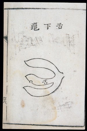 view C18 Chinese woodcut: Abscess underneath the tongue