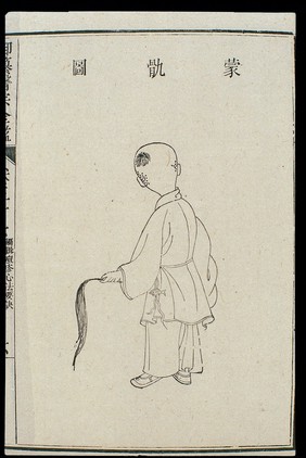 Chinese C18: Paediatric pox - 'Coccyx Enveloping' pox