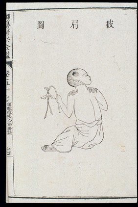 Chinese C18: Paediatric pox - 'Shoulder Cape' pox