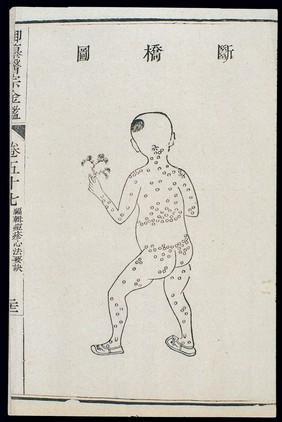 Chinese C18: Paediatric pox - 'Broken Bridge' pox