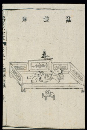 view Chinese C18: Paediatric pox - 'Silkworm Eggs' pox