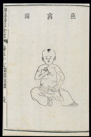 view Chinese C18: Paediatric pox - 'Swallow's Nest' pox