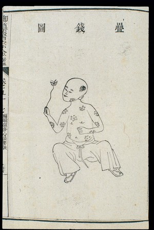view Chinese C18: Paediatric pox - 'Stacked Coins' pox