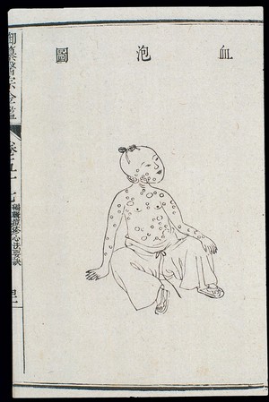 view Chinese C18: Paediatric pox - 'Blood Blister' pox